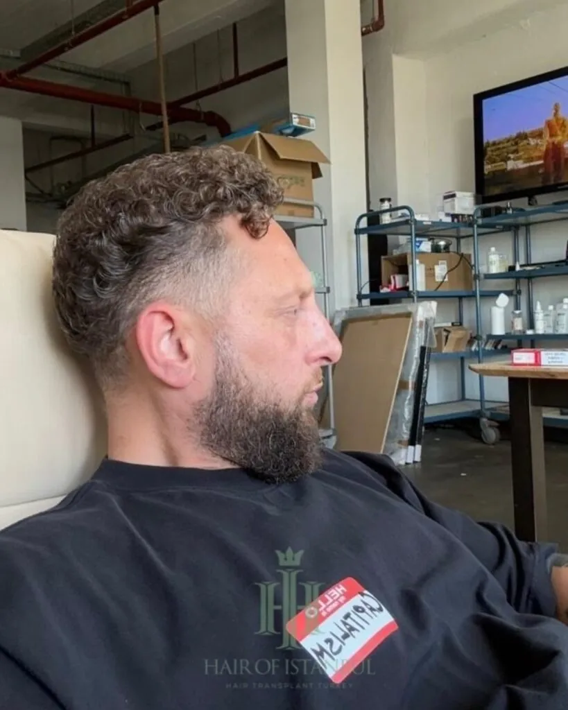 Before & After 96 Hair transplant result, 4,550 grafts, Year 2 (4) — Hair of Istanbul