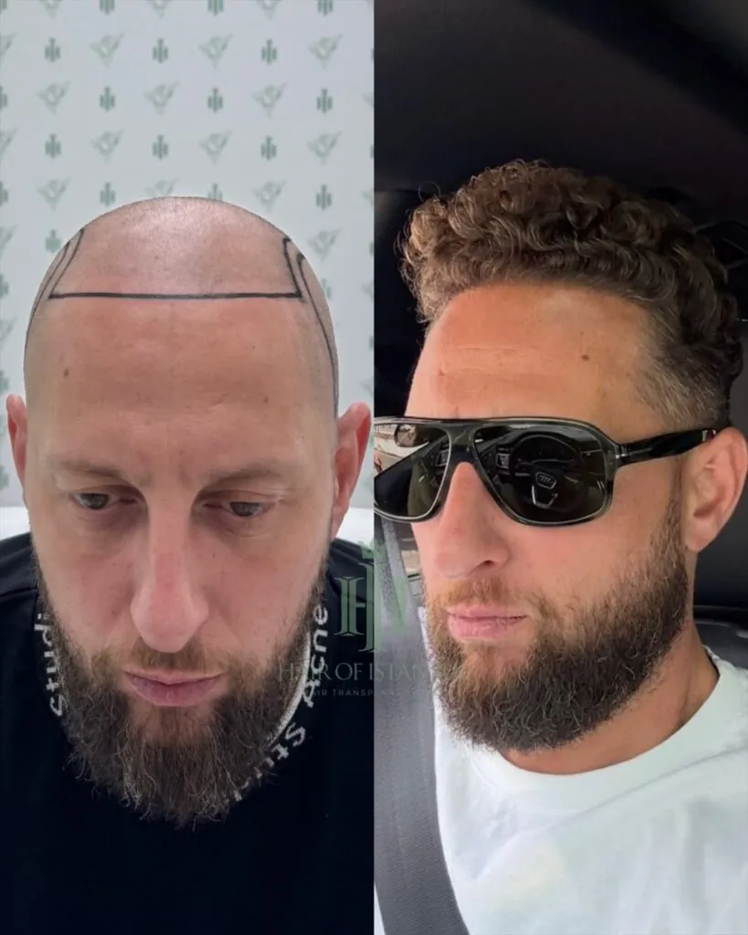 Before & After 87 Hair transplant result, 4,550 grafts, Before & After — Hair of Istanbul