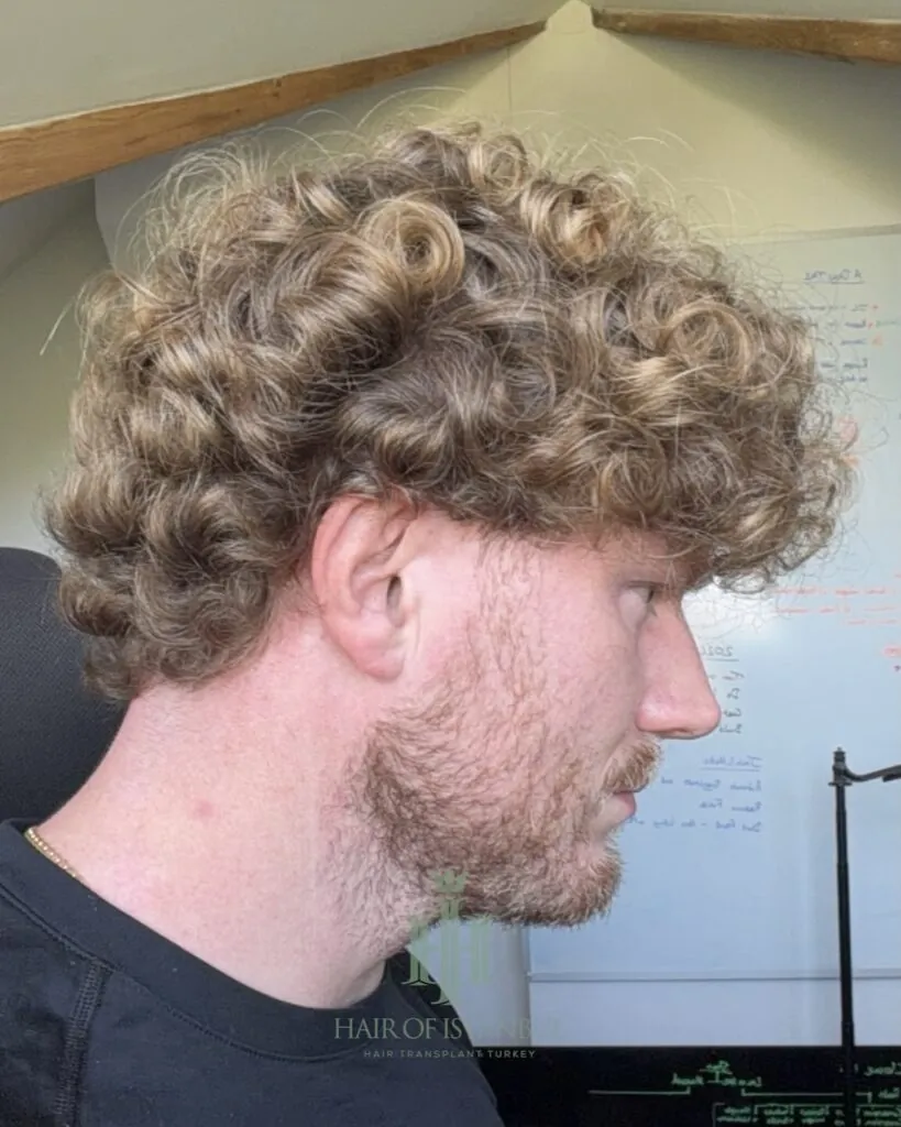 Before & After 122 Hair transplant result, 2,700 grafts, Month 12 (3) — Hair of Istanbul