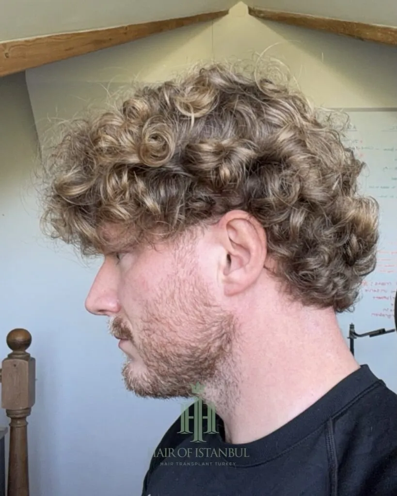 Before & After 121 Hair transplant result, 2,700 grafts, Month 12 (2) — Hair of Istanbul