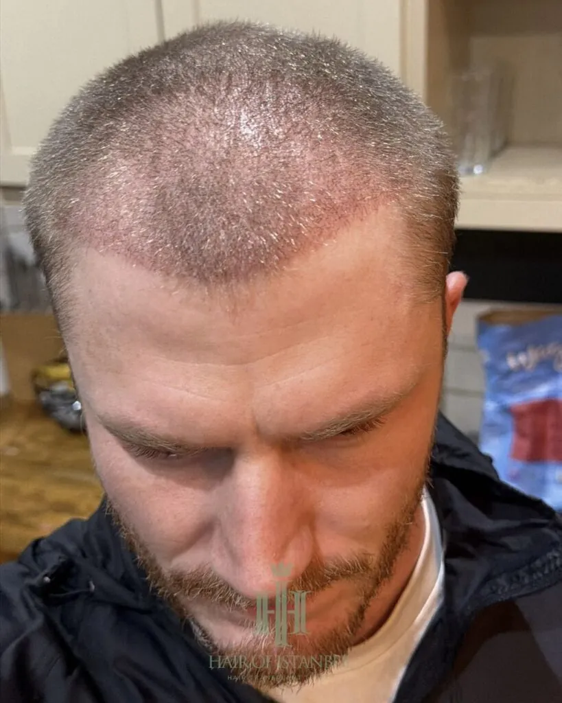 Before & After 118 Hair transplant result, 2,700 grafts, Month 1 — Hair of Istanbul