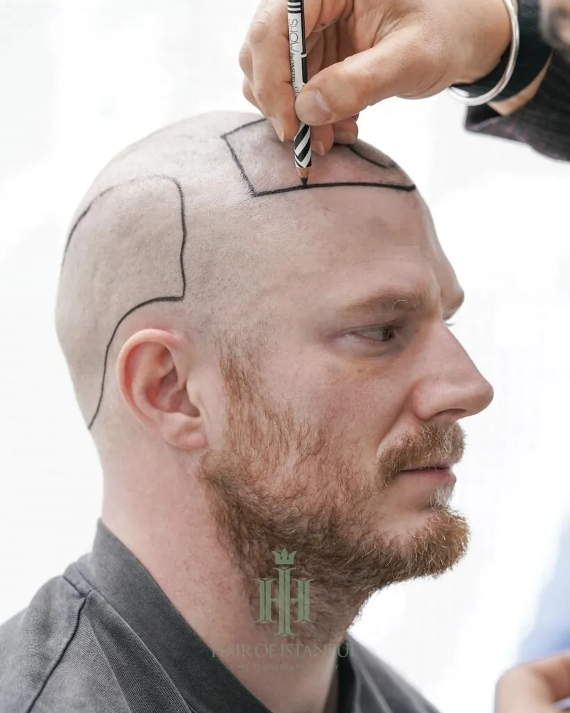Before & After 116 Hair transplant result, 2,700 grafts, Hairline design — Hair of Istanbul