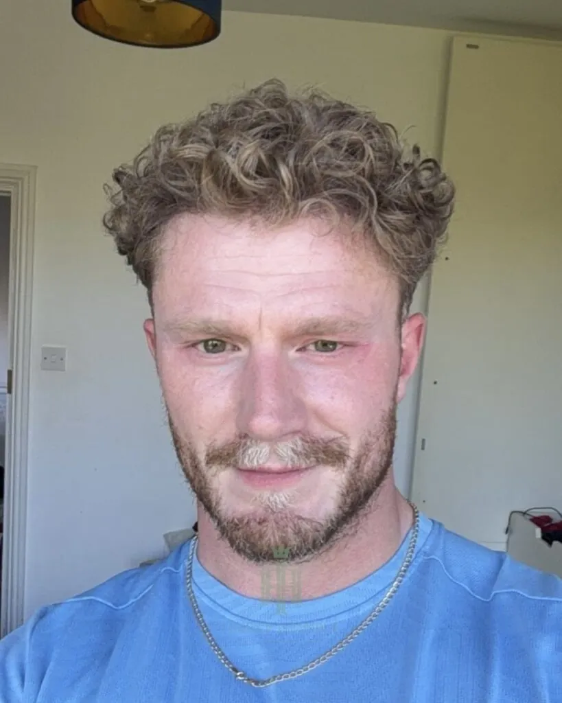 Before & After 119 Hair transplant result, 2,700 grafts, Month 6 — Hair of Istanbul