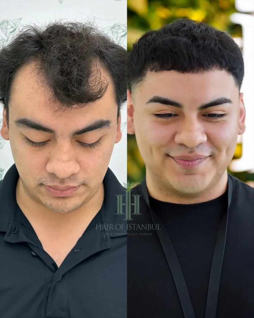 Before & After 75 Hair transplant result, 5,800 grafts, Before & After — Hair of Istanbul