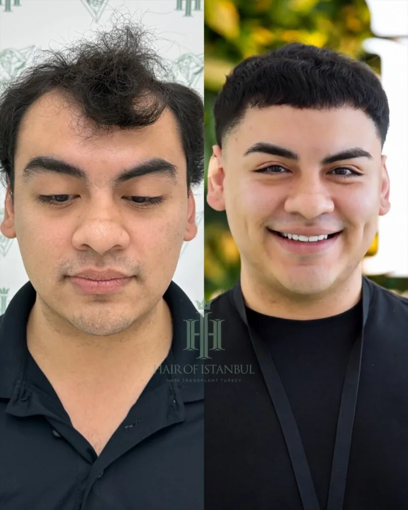 Before & After 76 Hair transplant result, 5,800 grafts, Before & After (2) — Hair of Istanbul