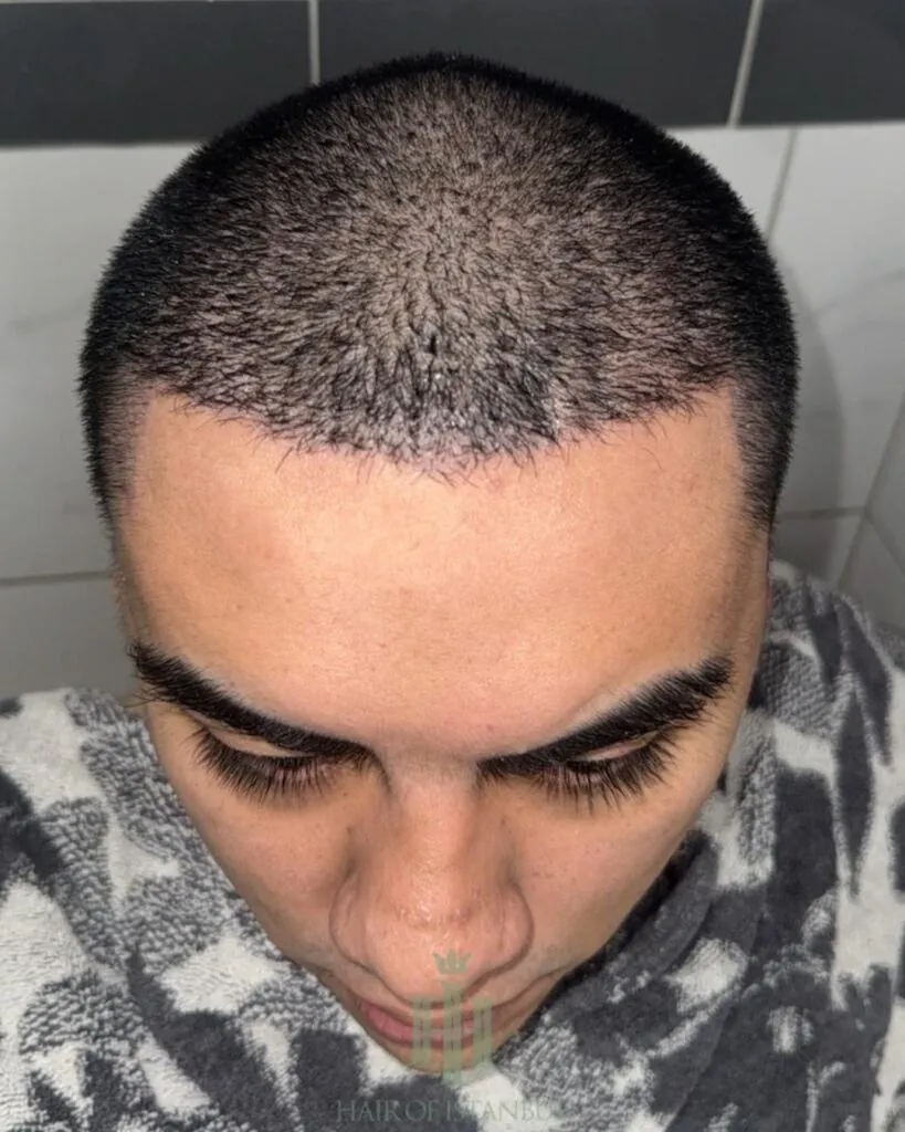 Before & After 81 Hair transplant result, 5,800 grafts, Month 1 — Hair of Istanbul