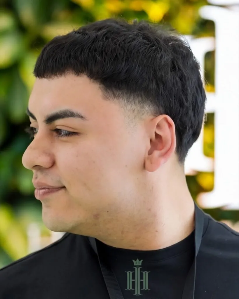 Before & After 85 Hair transplant result, 5,800 grafts, Year 2 (4) — Hair of Istanbul