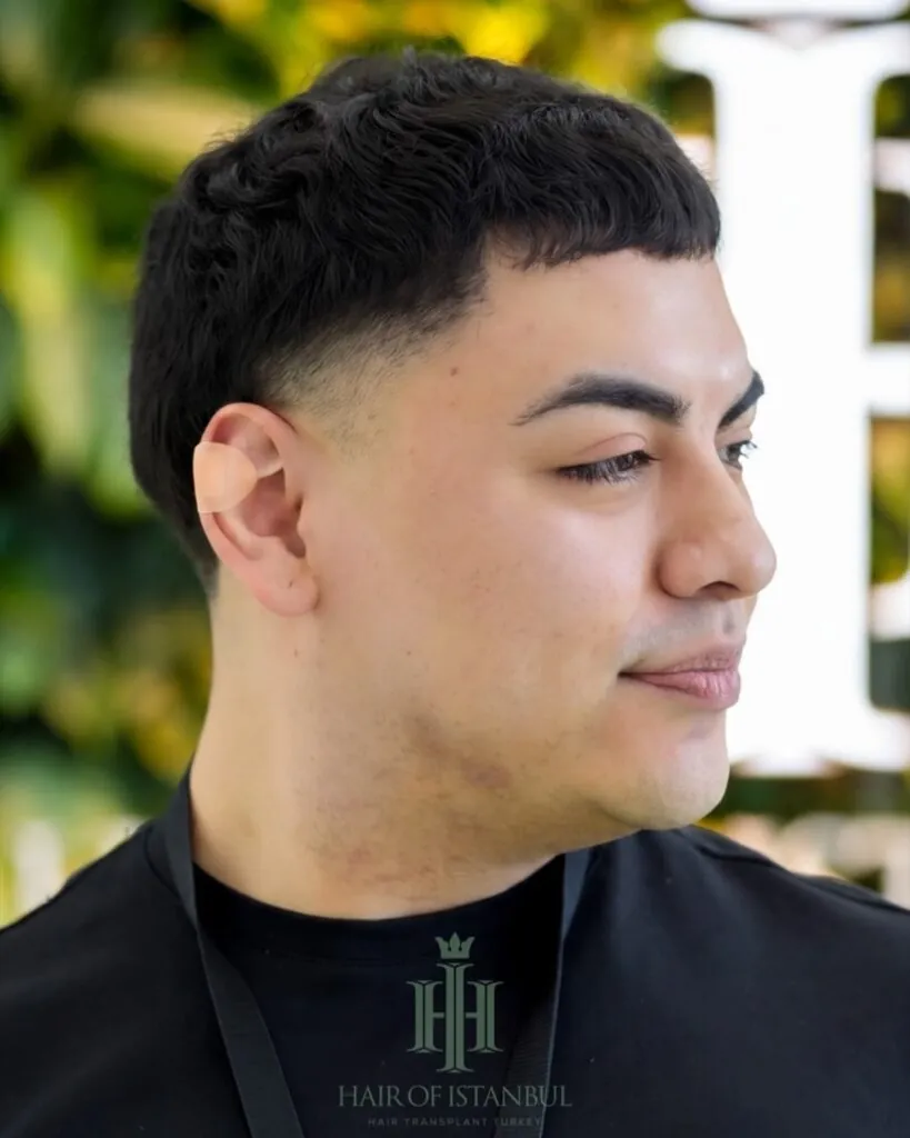 Before & After 84 Hair transplant result, 5,800 grafts, Year 2 (3) — Hair of Istanbul