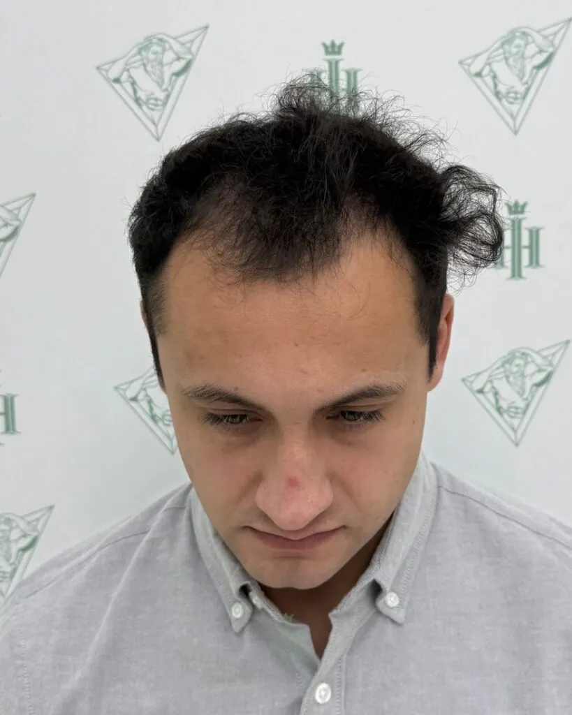 Before & After 48 Hair transplant result, 4,400 grafts, Before — Hair of Istanbul