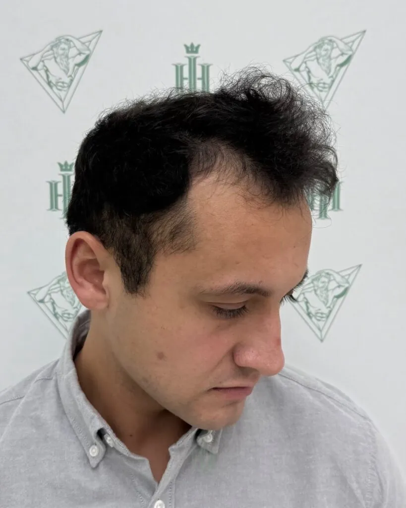 Before & After 50 Hair transplant result, 4,400 grafts, Before (3) — Hair of Istanbul