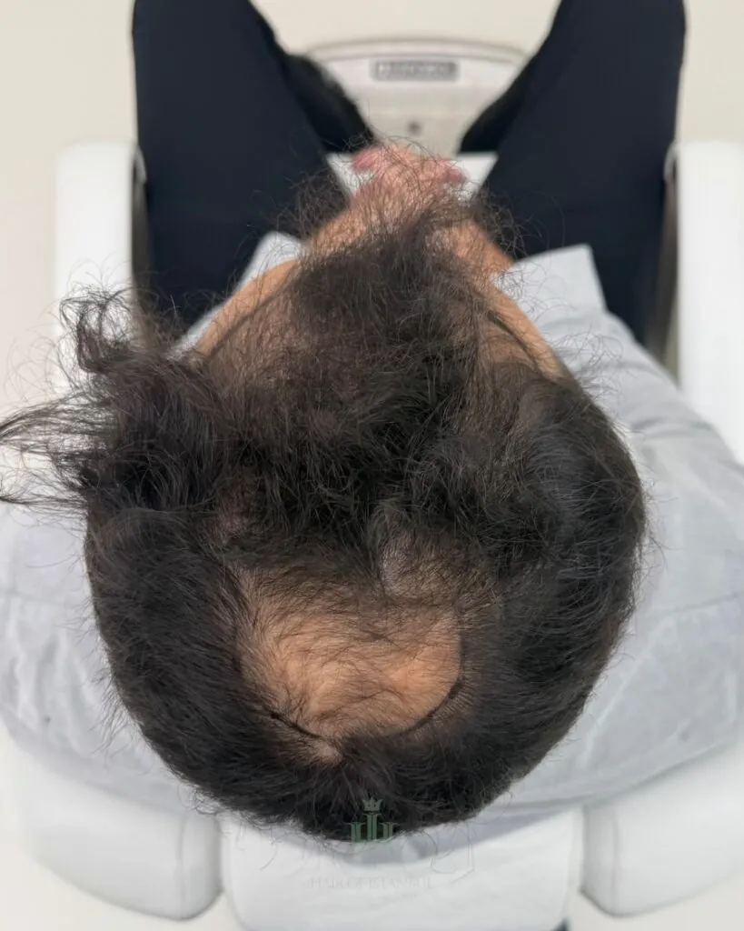 Before & After 51 Hair transplant result, 4,400 grafts, Before (4) — Hair of Istanbul