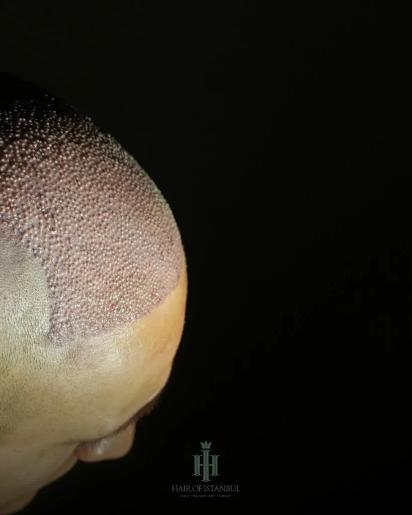 Before & After 57 Hair transplant result, 4,400 grafts, Day 1 — Hair of Istanbul