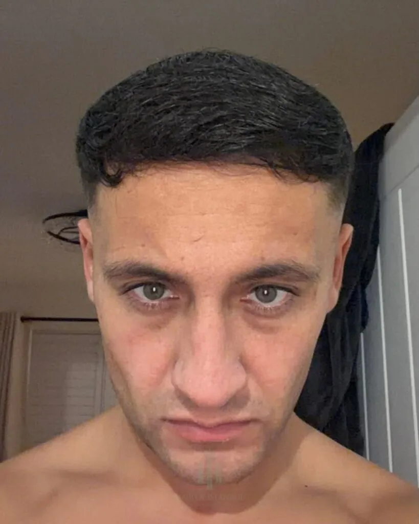 Before & After 62 Hair transplant result, 4,400 grafts, Month 9 — Hair of Istanbul