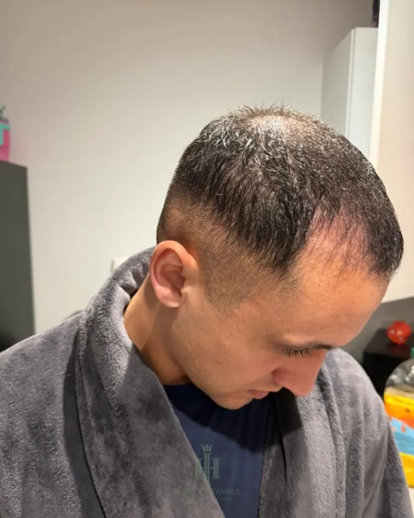 Before & After 59 Hair transplant result, 4,400 grafts, Month 1 (2) — Hair of Istanbul