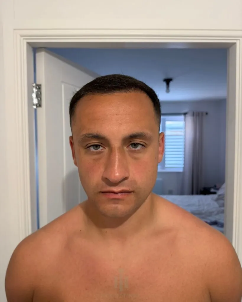 Before & After 60 Hair transplant result, 4,400 grafts, Month 4 — Hair of Istanbul