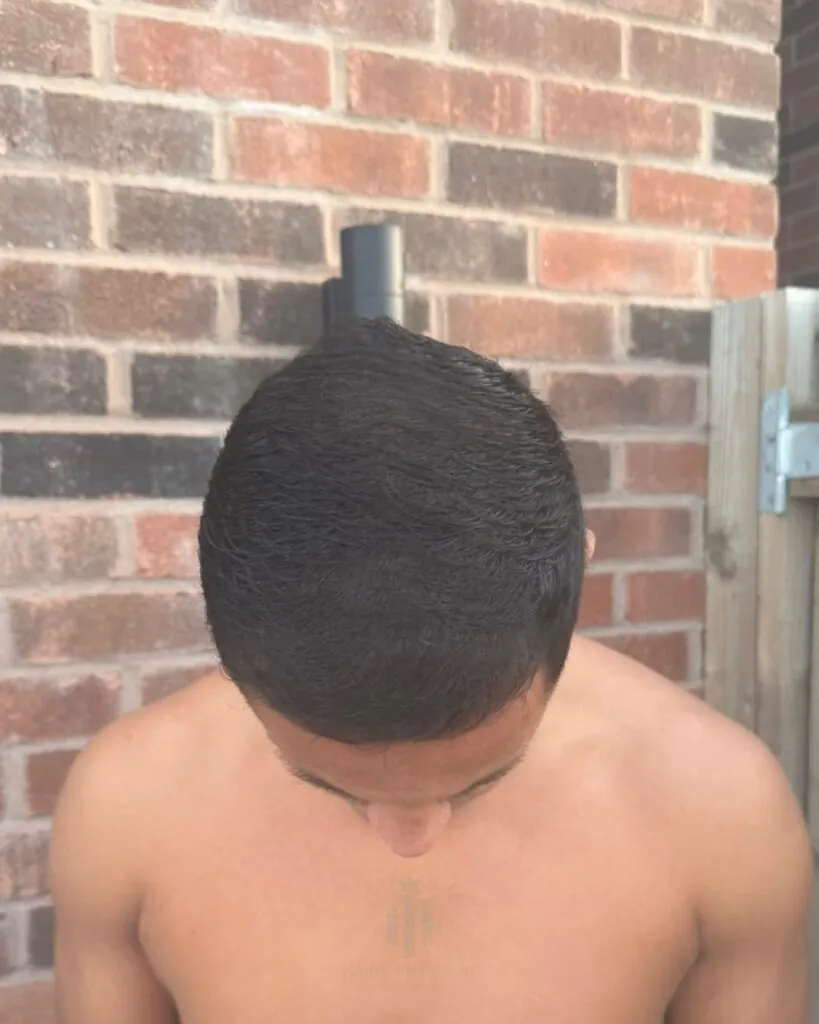 Before & After 61 Hair transplant result, 4,400 grafts, Month 5 — Hair of Istanbul