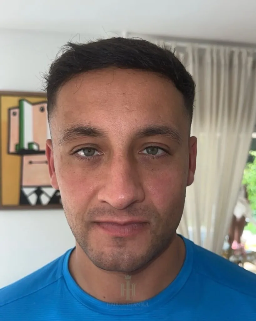 Before & After 63 Hair transplant result, 4,400 grafts, Month 9 (2) — Hair of Istanbul