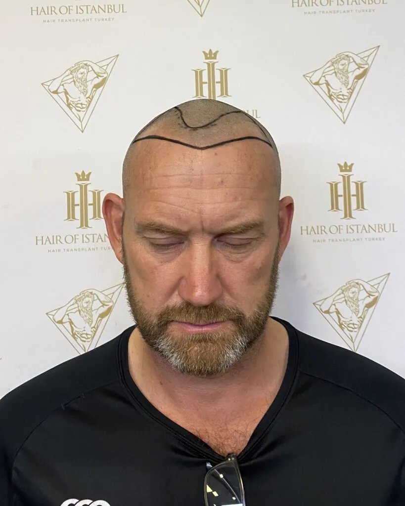 Before & After 101 Hair transplant result, 2,100 grafts, Hairline design — Hair of Istanbul
